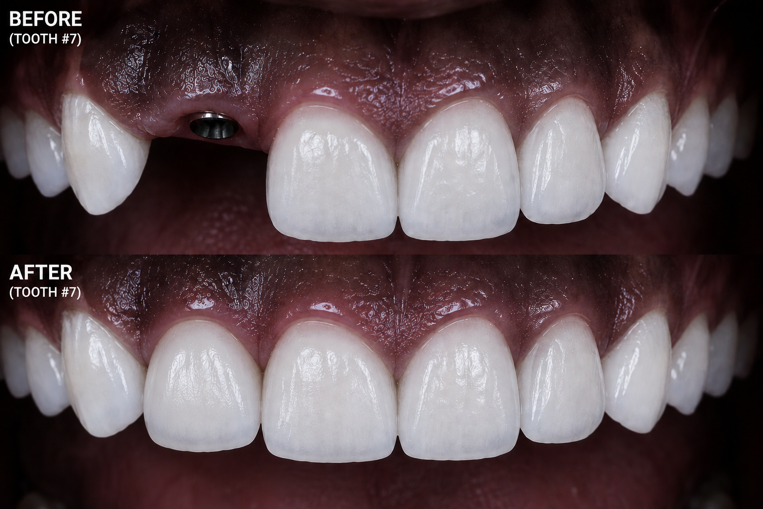 Bone graft and implant result North Hollywood