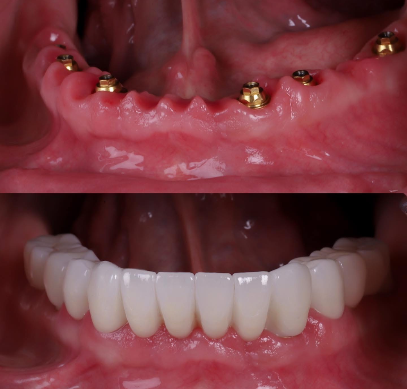 All-on-4 recovery result North Hollywood