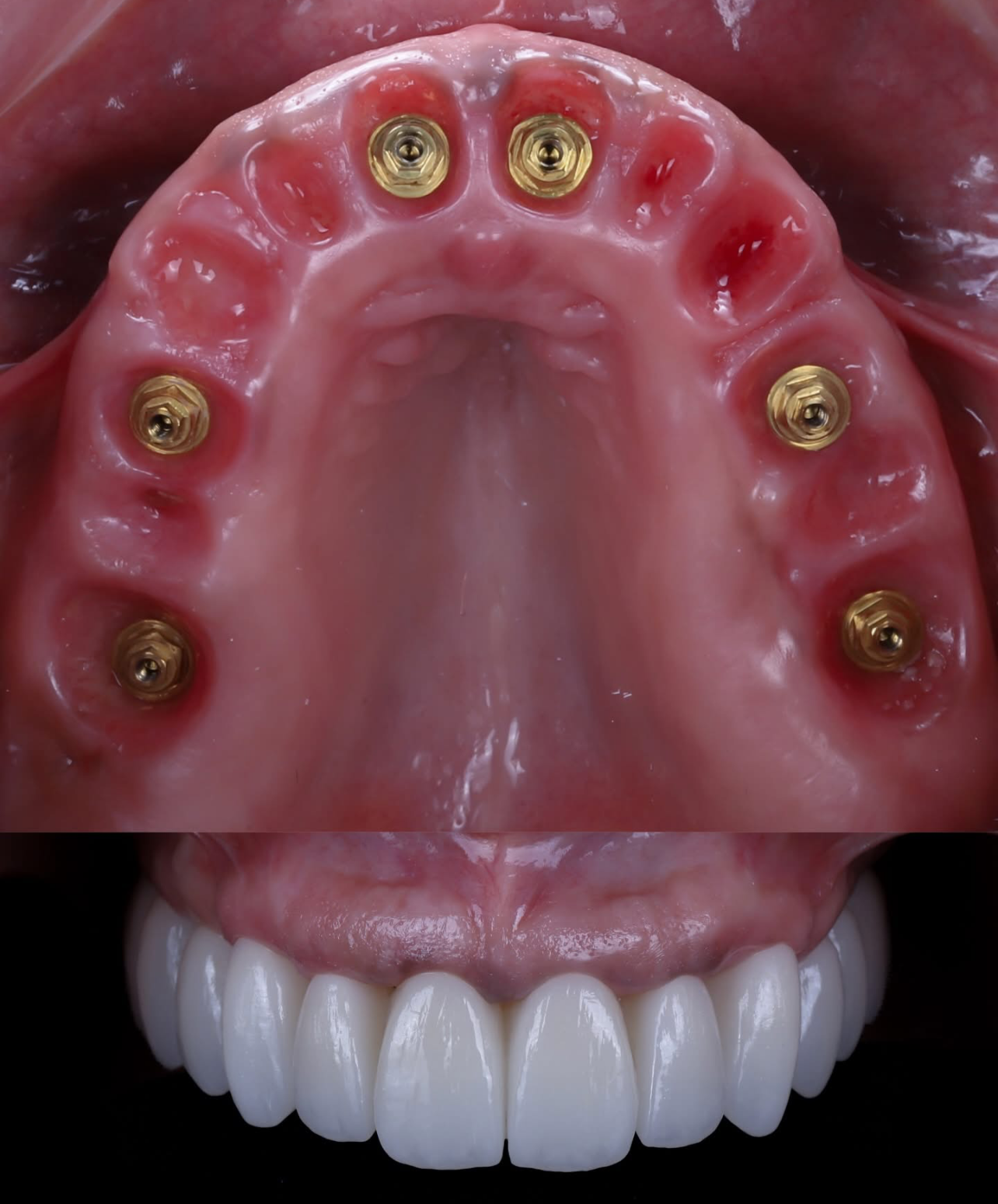 Full arch zirconia bridge result North Hollywood